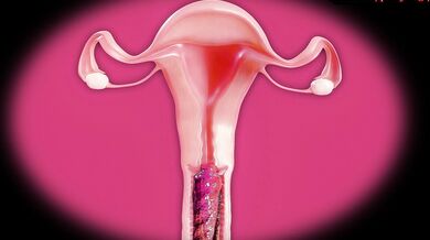 Stretching Tifa's Swamp with X-ray Tentacles